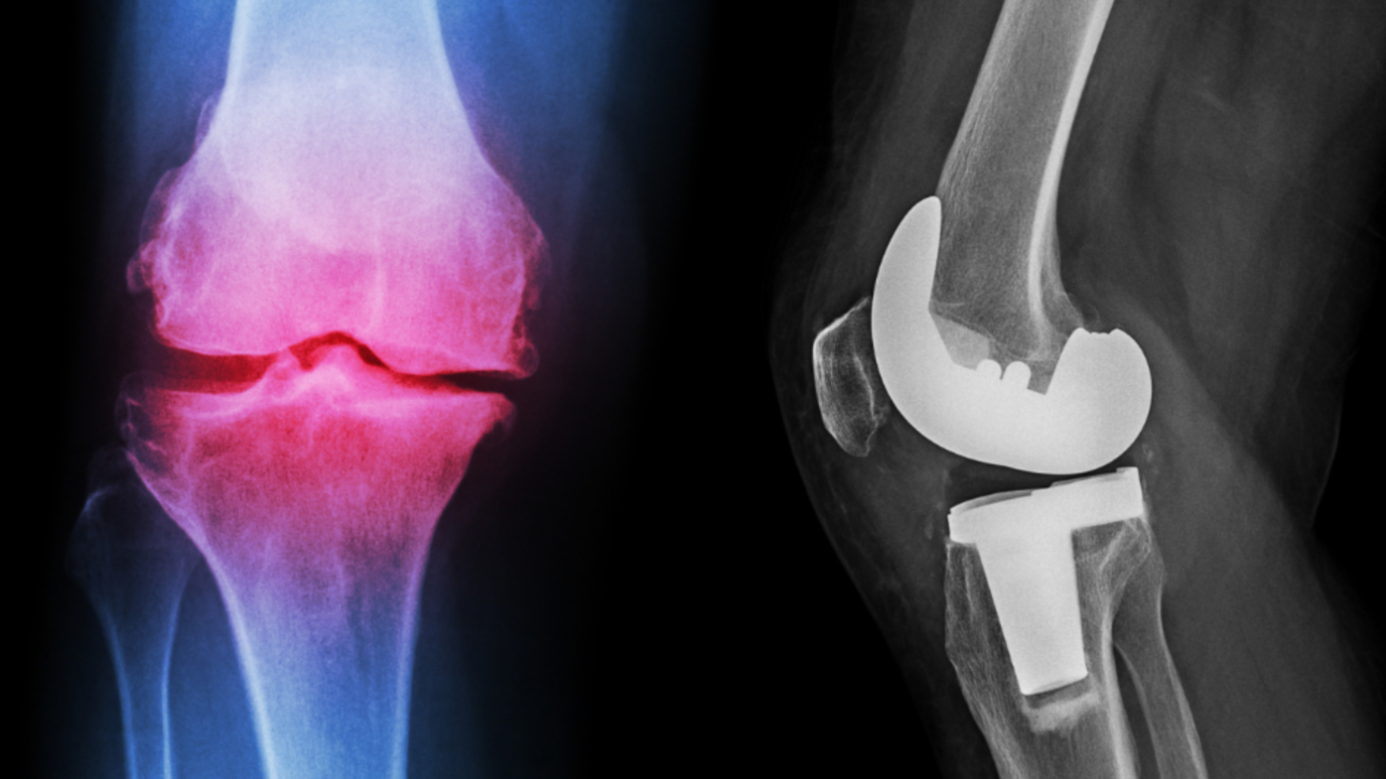 Total Knee Replacement - bonesandskin.in